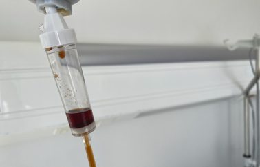 Iron staining and IV iron infusions